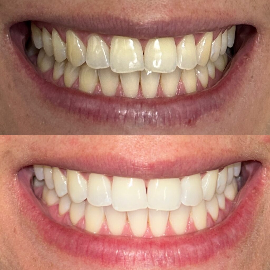 antes-depois-clareamento-dental-feminino-billig-odontologia