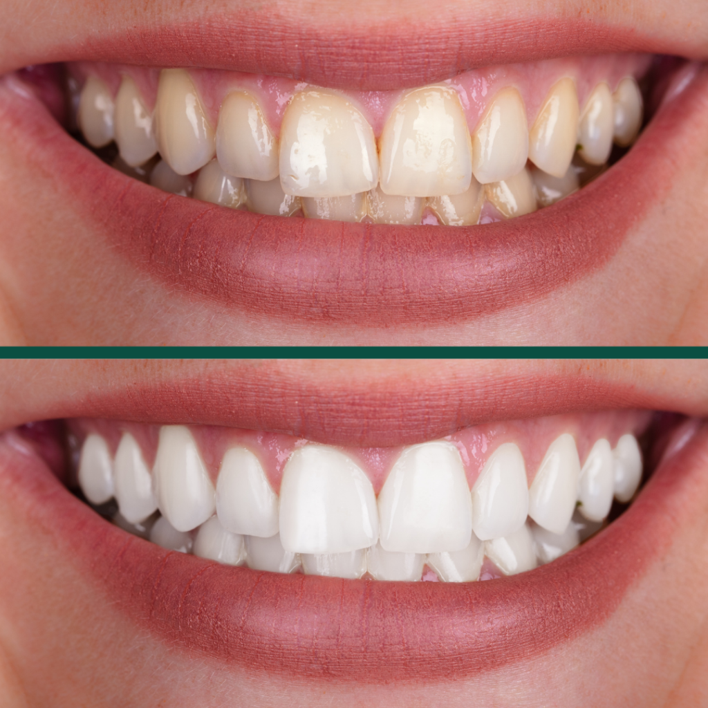 Antes e depois de clareamento dental realizado na Billig Odontologia - Asa Norte Brasília
