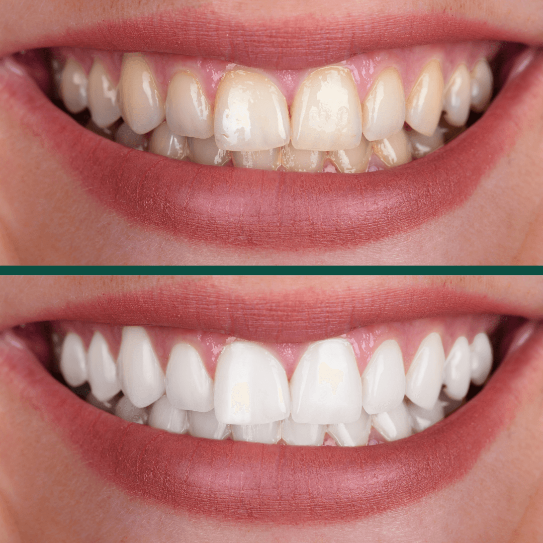 Antes e depois de clareamento dental feminino — Billig Odontologia