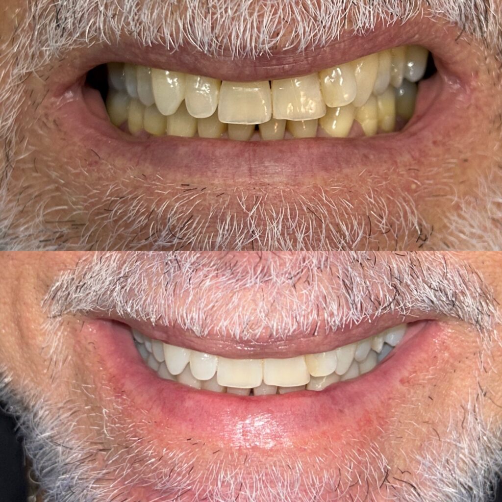 Resultado de clareamento dental masculino antes e depois na Billig Odontologia - Asa Norte Brasília
