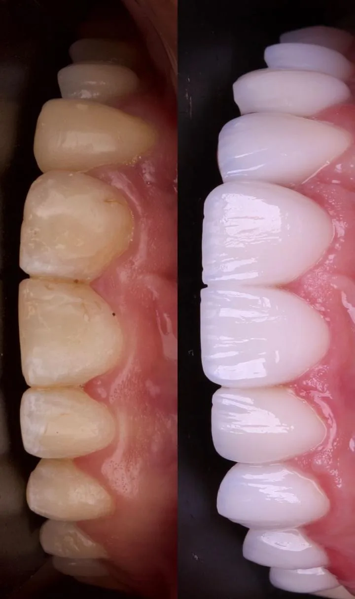 Antes e depois de lentes de contato dental na Billig Odontologia — resultado em Brasília