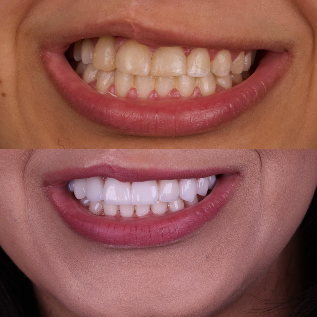 Antes e depois de lentes de contato dental na Billig Odontologia — resultado em Brasília