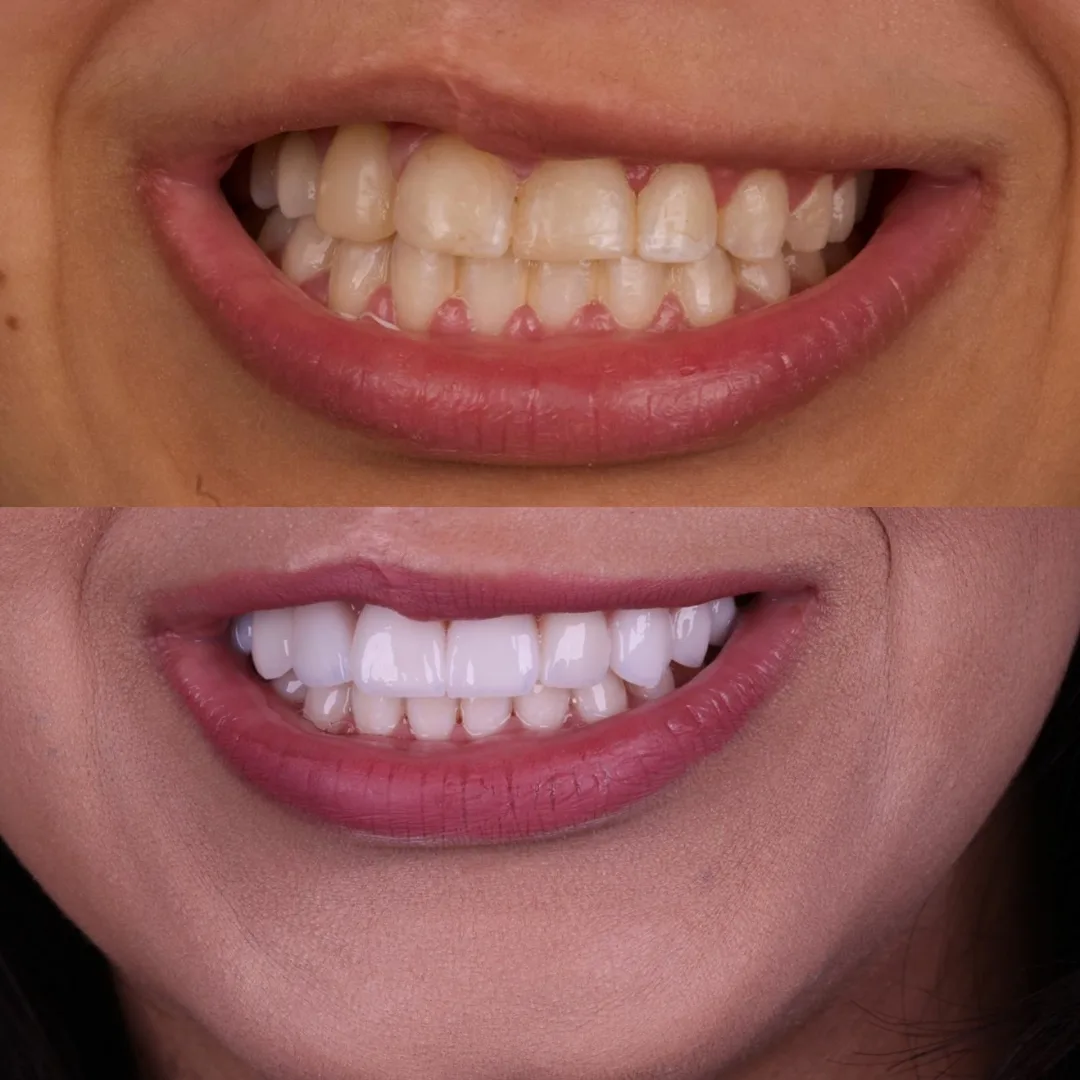 Antes e depois de lentes de contato dental na Billig Odontologia — resultado em Brasília